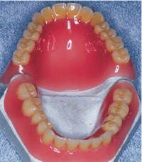 Техника изготовления съемных зубных протезов и применяемый материал